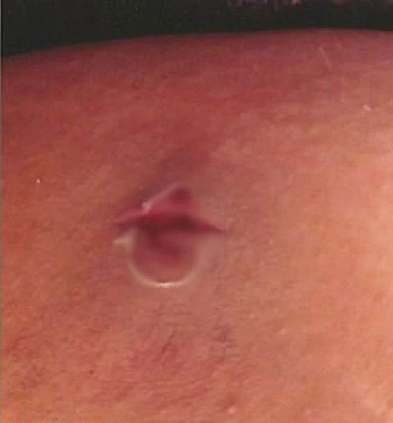 Kasığındaki çıban hayatını mahvetti