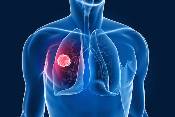 Akciğer kanseri yılda 1,6 milyon kişiyi vuruyor