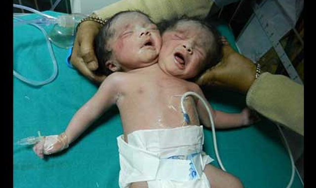 Hindistan&#039;da tek vücutlu çift başlı bebek dünyaya geldi