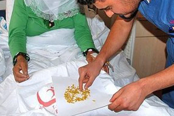 Safra kesesinden çıkan taşlar şaşırttı
