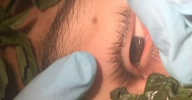 İnanılmz olay, gözünden kurt çıkardılar