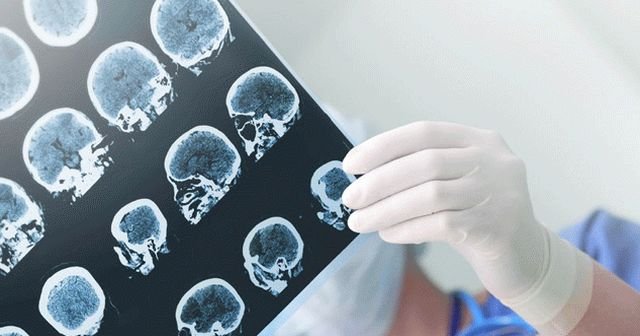 Beyinde baloncuk (Beyin Anevrizması) nedenleri, belirtileri, tedavisi