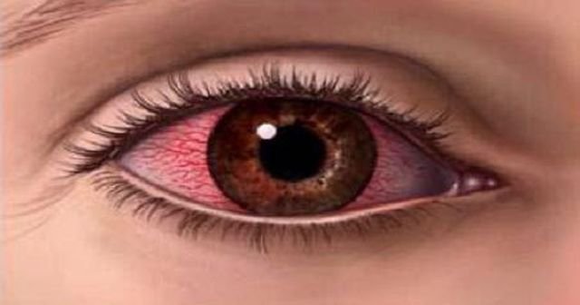Göz iltihabına ne iyi gelir? Göz enfeksiyonu bitkisel tedavi yolları