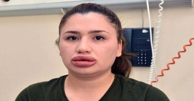 İşte silikondan dudaklarını kaybetmek üzere olan hemşirenin son hali