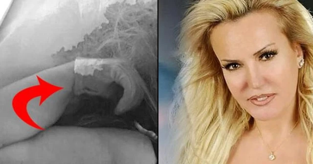 Filiz Aker’in sağ elindeki eldivenin sırrı çözüldü