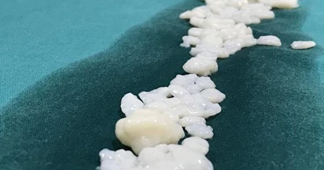 Dizlerinden 967 adet eklem faresi çıktı
