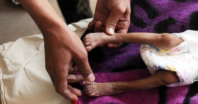 Yemen&#039;deki difteri salgınında hayatını kaybedenlerin sayısı 34&#039;e yükseldi