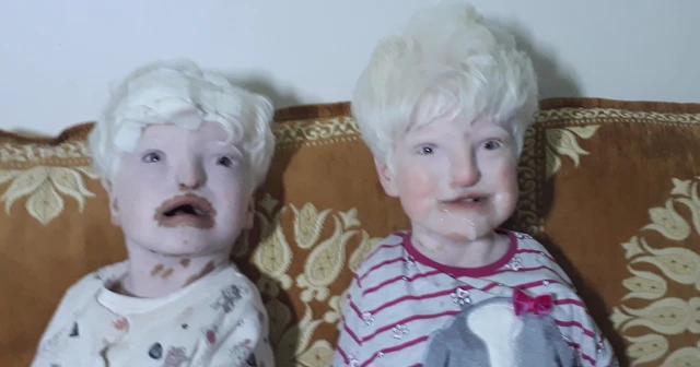 Albino kardeşler yardım bekliyor
