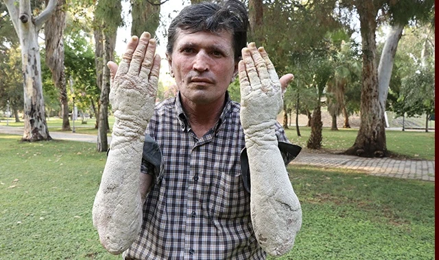 Hastalığı değil, insanların kendini görünce korkup uzaklaşması kahrediyor