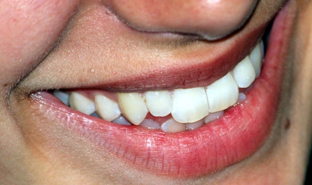 Diş beyazlatma yöntemleri evde nasıl diş beyazlatılır