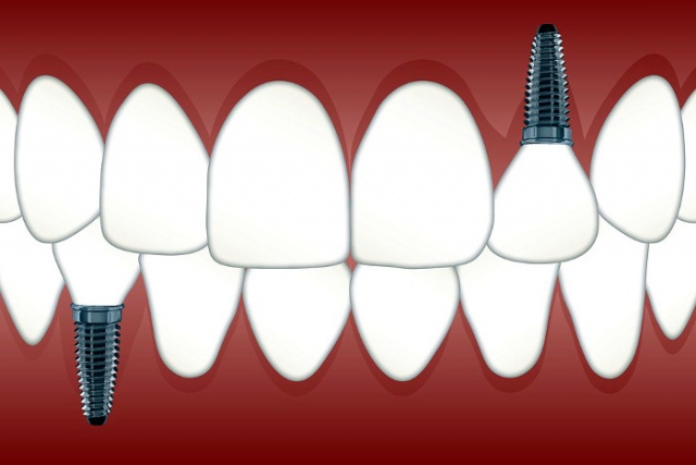 Implant diş uygulaması diş implantı nedir nasıl uygulanır
