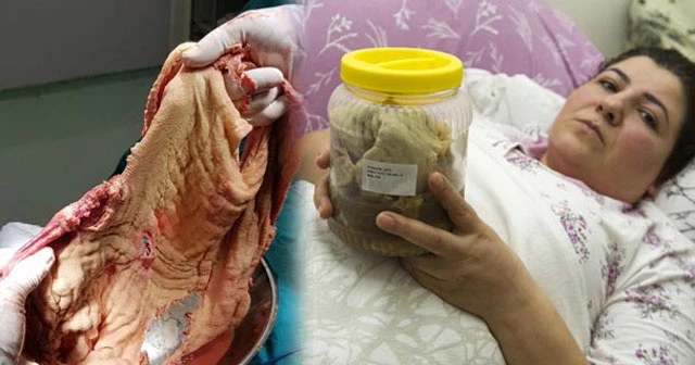 Korkunç gerçek sezaryen doğum sonrası ağrıları bitmeyince ortaya çıktı