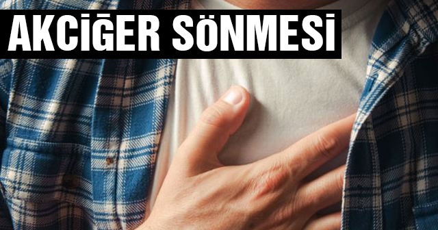 Akciğer sönmesi nedir? Akciğer sönmesi neden olur? (Nagatomo teşhisi Akciğer Sönmesi kimlerde görülür)