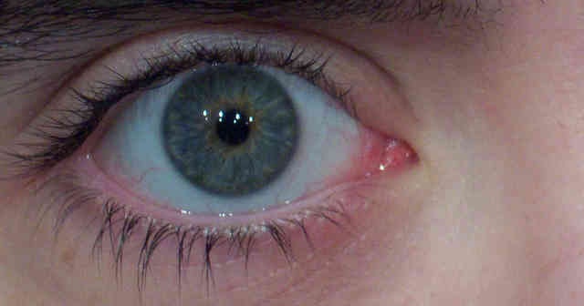 Göz Seğirmesi Nedir Göz Seğirmesi Neden Olur? Sağ göz seğirme nedenleri