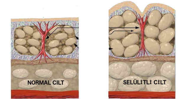 Selülit nedir neden oluşur nasıl tedavi edilir selülit neden olur nasıl geçer