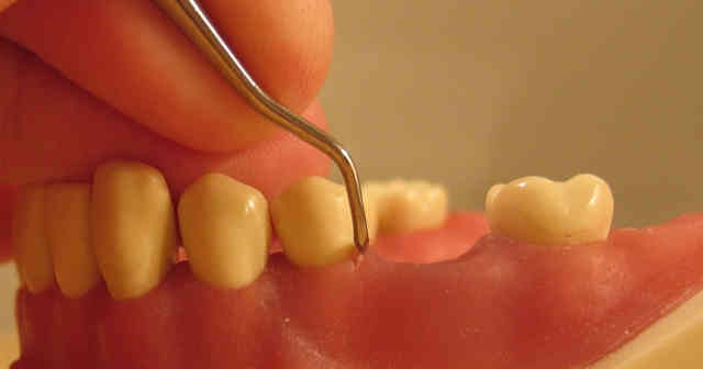 Diş İltihabına Ne İyi Gelir Nasıl Geçer Evde Tedavi Yöntemleri
