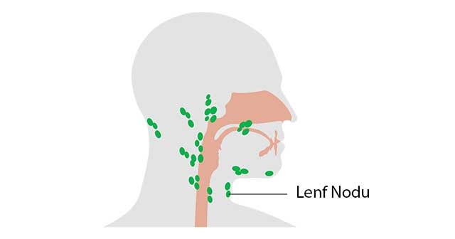 Lenf nodu nedir neden olur Lenf nodu şişmesi belirtileri kanser mi?