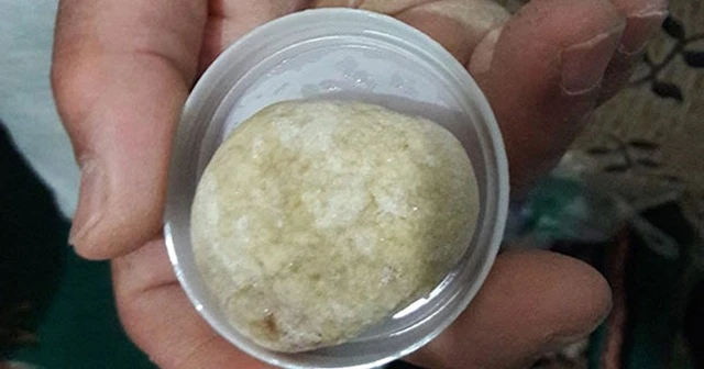 Mesanesinden 300 gram ağırlığında taş çıktı