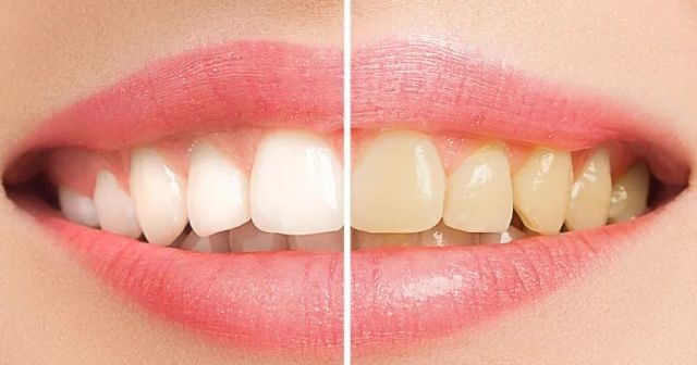Beyaz diş nasıl görünür nasıl diş beyazlatılır, Diş beyazlatma yöntemleri nelerdir?