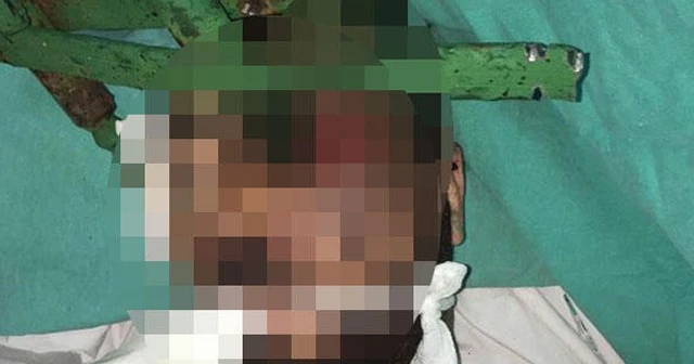Korkunç olay! Yüzüne demir çubuk saplandı