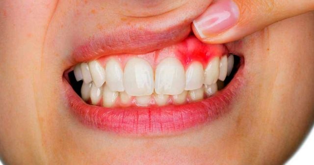 Gingivit nedir, Gingivit belirtileri nelerdir neden olur, gingivit diş eti rahatsızlığı nedir