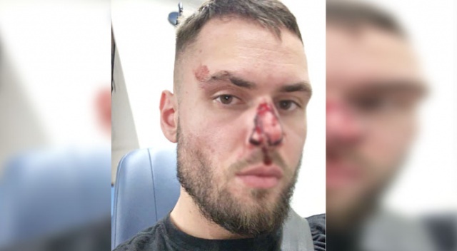Alman polisi Türk gencin burnunu kırdı