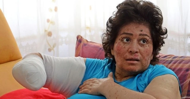 Hastalığı yüzünden sağ kolu kesilecek olan Sibel Oflas yardım istedi