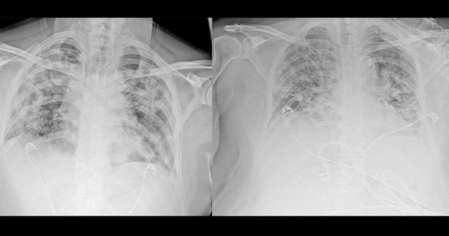 Koronavirüsün akciğerdeki ağır tahribatı, hastaların tomografi görüntülerine yansıdı