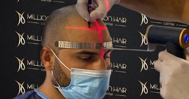 Million Hair Center CEO' su Fatih Köse: 'Saç ekiminin en önemli noktaları ön saç çizgisi ve doğal görünümdür'