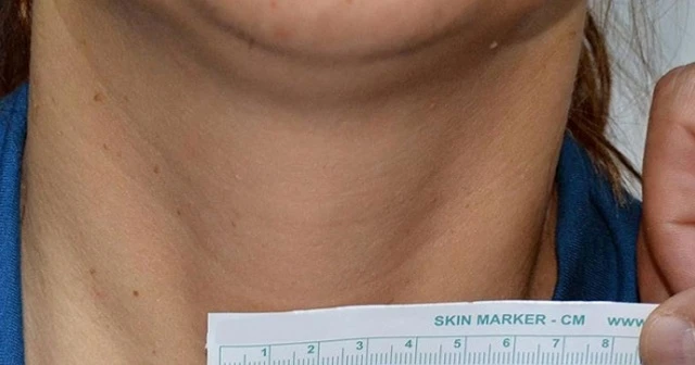 Koronavirüslebirlikte ağrılı tiroit hastalığı arttı