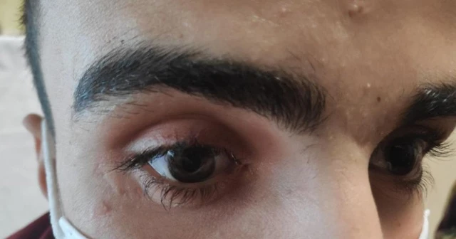 Gözünde unutulan cam kırığı ile bir ay yaşadı