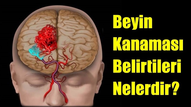 Beyin Kanaması (Anevrizma) Nedir? Beyin Kanaması Öldürür mü?