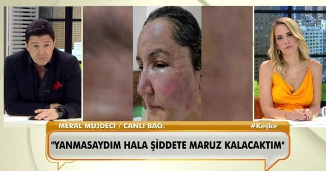 Canlı yayında bağlanan kadın, eşinin kendisini kızgın yağ ile yaktığını söyledi