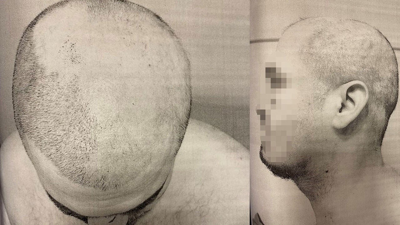 Yurt sahibi müdüre işkence etti: Gözlerini bağladı, sıcak ağda ile sakal ve saçlarını kopardı