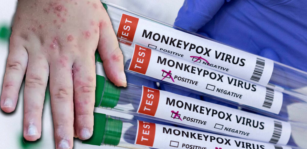 Monkeypox, öncelikle Orta ve Batı Afrika'nın tropikal yağmur ormanlarında ortaya çıkan ve zaman zaman diğer bölgelere ihraç edilen viral bir zoonotik hastalıktır.