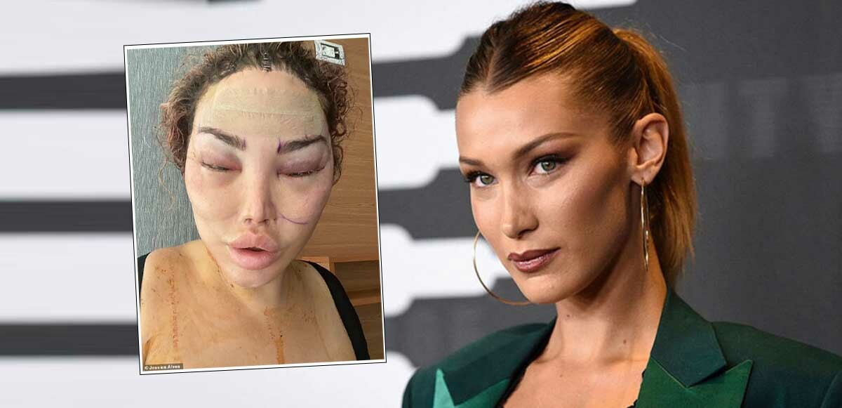 Son 20 yılda 90&#039;ın üzerinde estetik ameliyat geçirdi! Bella Hadid&#039;e benzemek için bu hale geldi: Ödediği miktar dudak uçuklattı