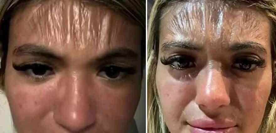 Bulgaristan’a tatile geldi kabusu yaşadı! İngiliz kadının yüzü plastik gibi gerildi