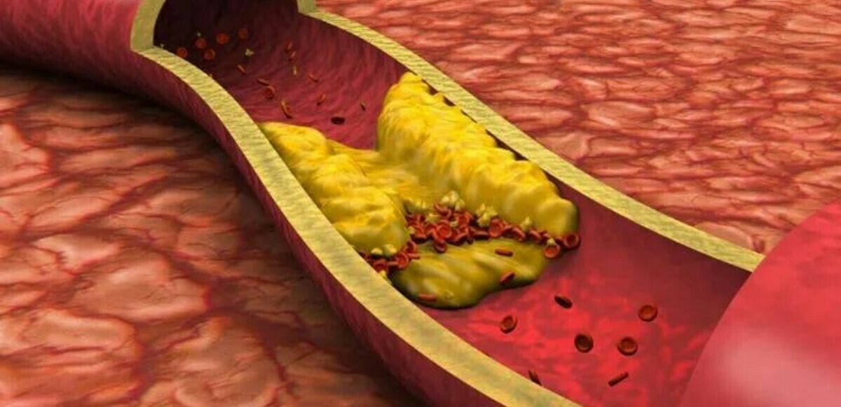 Kalp ve damar hastalıklarının başlıca sebebi kolesterol neden olur? İşte kolesterole karşı alınabilecek önlemler!