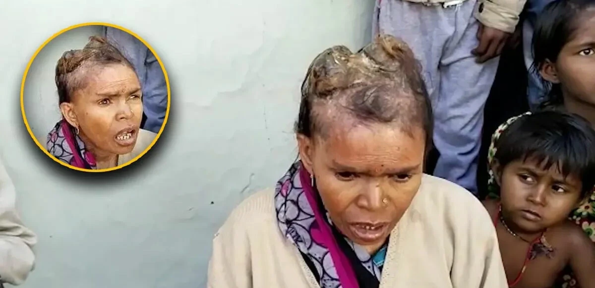 Kadının kafasındaki boynuzları gören şaşıp kalıyor! 3 sene önce dayanılmaz ağrılarla başladı