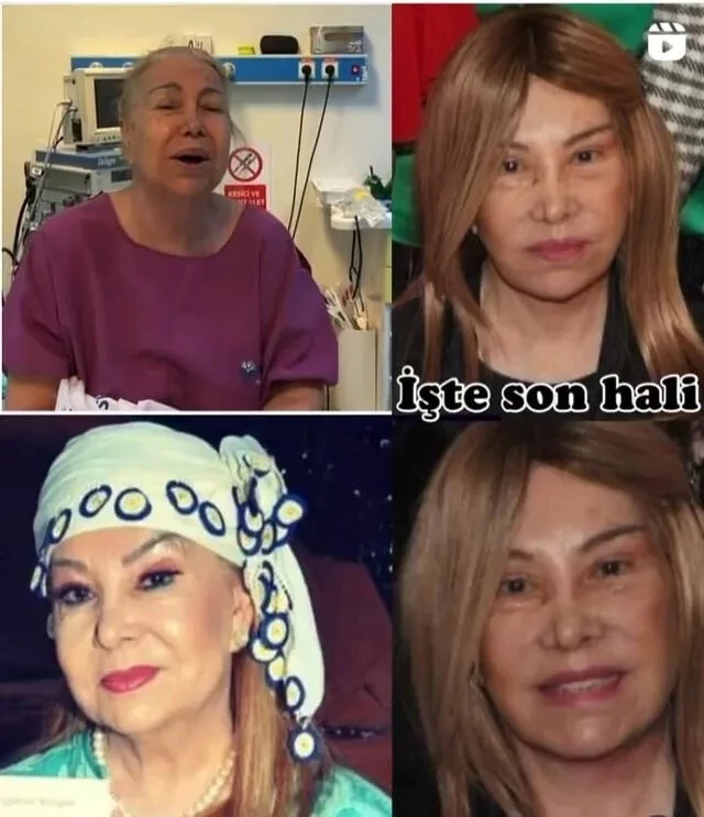 Usta sanatçı Bedia Akartürk de estetik kervanına katıldı: Daha genç, daha güzel görünmek istiyorum!