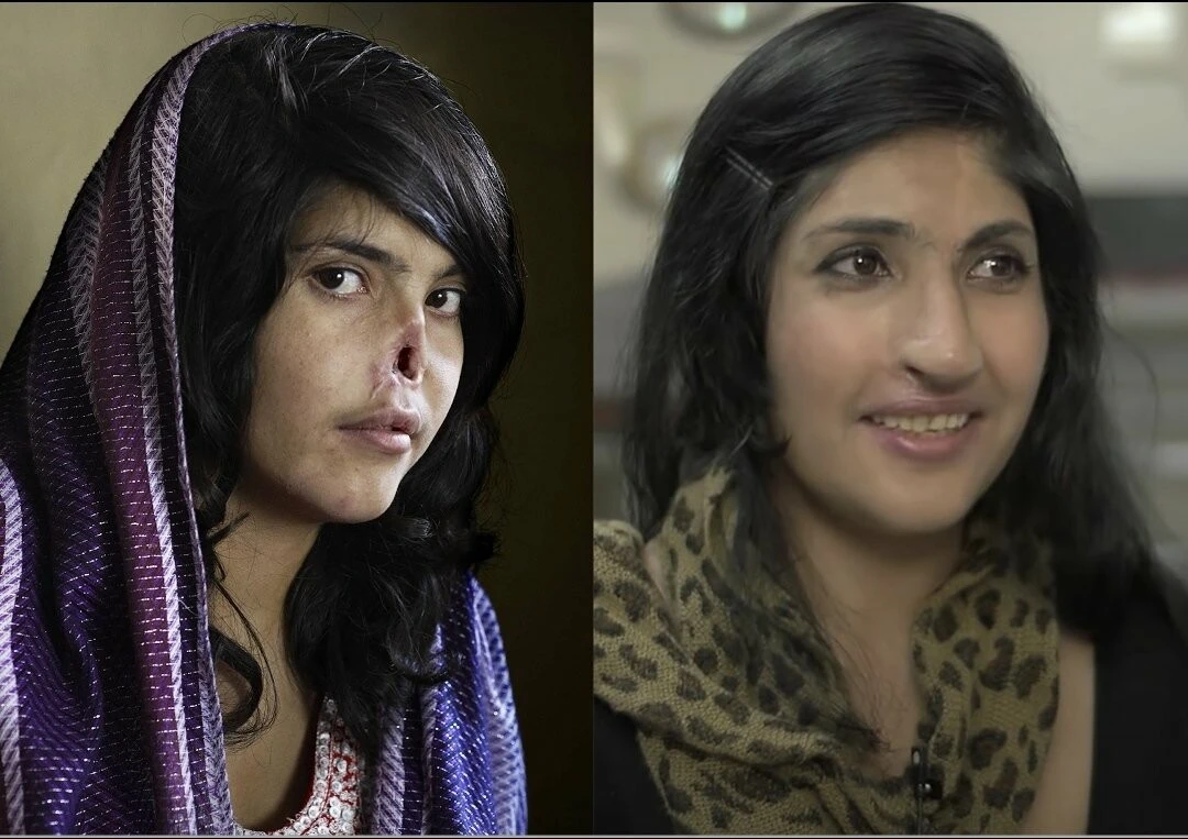 Taliban üyesi kocası tarafından burnu kesilen Bibi Aisha, yaşadıklarını Anjelina Jolie’ye anlattı!