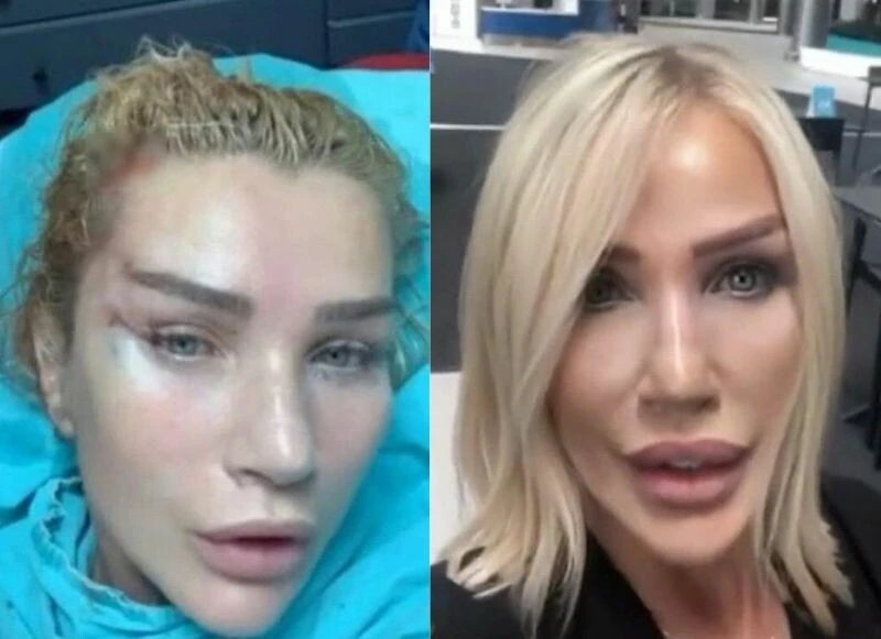 60 yaşındaki Seda Sayan ‘Barbie Bebek’ uygulamasıyla bacaklarına estetik yaptırdı!