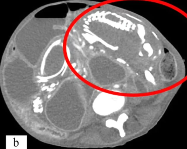 Cenin rahmi yerine bağırsaklarında oluştu! Dünyada yalnızca 300 kez görülen vaka