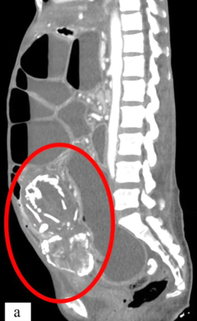Cenin rahmi yerine bağırsaklarında oluştu! Dünyada yalnızca 300 kez görülen vaka