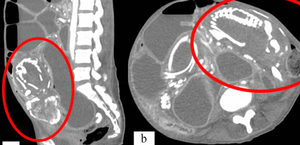 Cenin rahmi yerine bağırsaklarında oluştu! Dünyada yalnızca 300 kez görülen vaka
