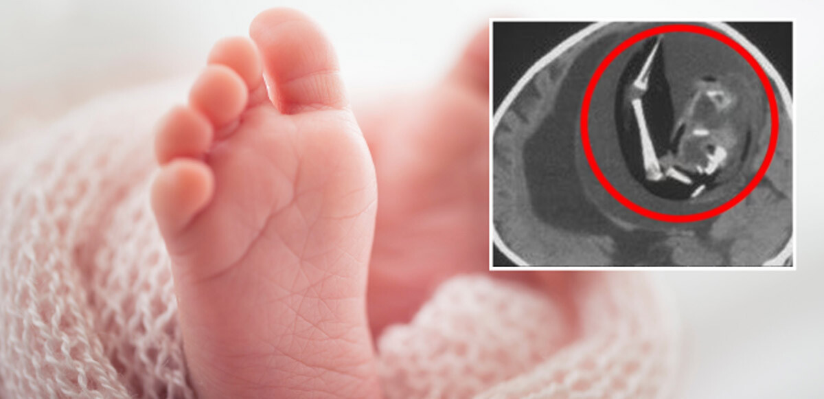 Çin&#039;de bir garip olay! Bir bebeğin beyninden ikizi çıkarıldı