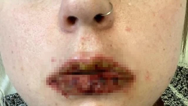 Vücudunda yaralar, derisinde pul pul dökülmeler kullandığı ilaçlardan oldu! Doktorlar bile şaştı