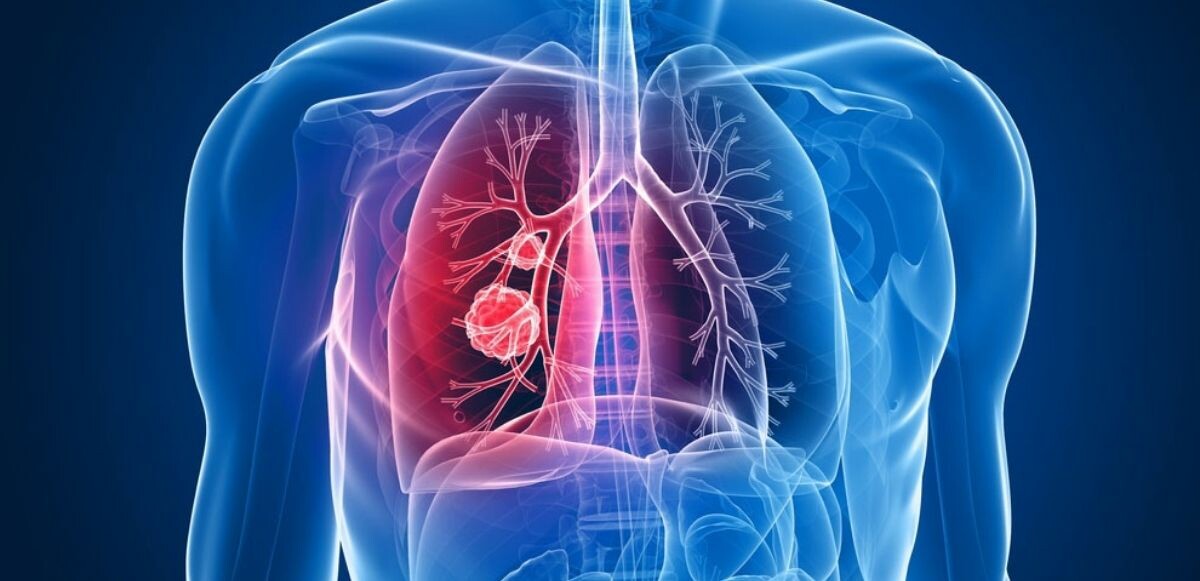 Bu 8 belirti sizde varsa akciğer kanseri olabilirsiniz! Halsizliği hafife almayın!