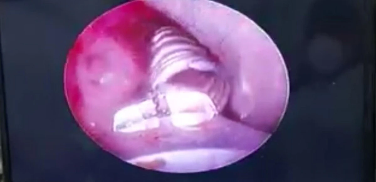 3 aydır öksüren çocuğun akciğerinden çıkanlar şoke etti! Doktorlar bile şaşkınlığını gizleyemedi