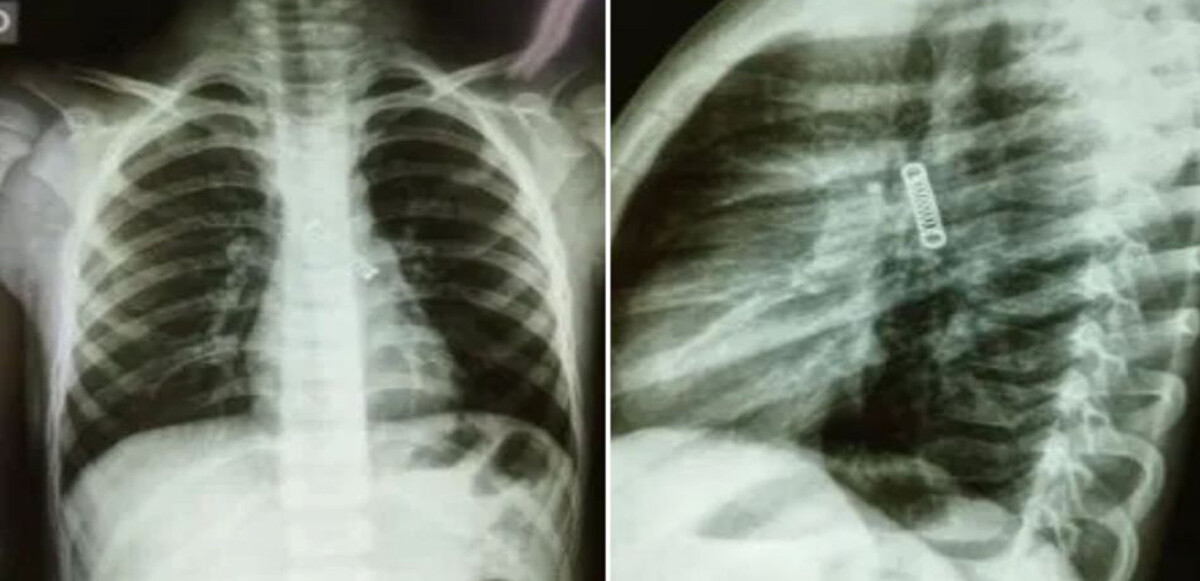 3 aydır öksüren çocuğun akciğerinden çıkanlar şoke etti! Doktorlar bile şaşkınlığını gizleyemedi